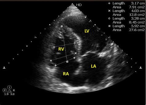 normal 2d echo
